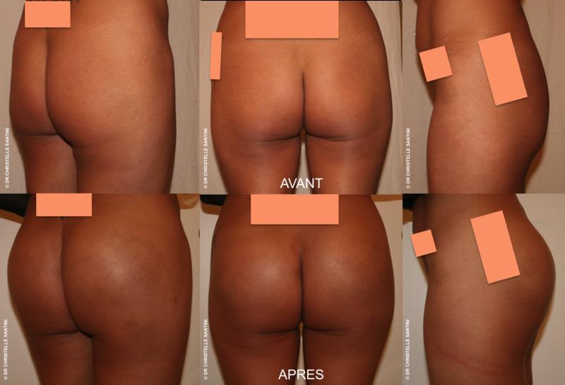 Patiente de 39 ans présentant des fesses plates ayant bénéficié de la pose d'Implants ou prothèses de fesses. intervention réalisée par le Docteur Christelle Santini, chirurgien esthétique à Paris Docteur Santini Chirurgien esthétique Paris